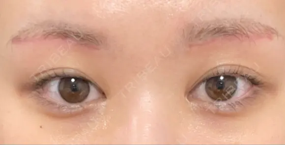 眼瞼下垂（切開） 水の森美容クリニック 福岡院 DAY 50 メイン用