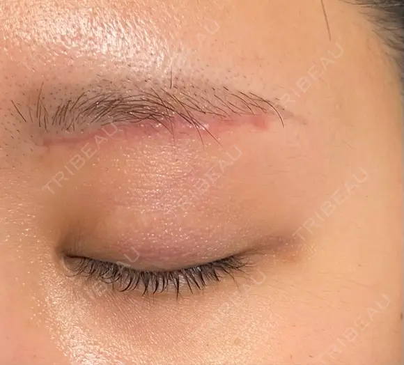 眼瞼下垂（切開） 水の森美容クリニック 福岡院 DAY 50 メイン用