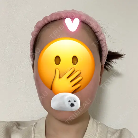 脂肪吸引（顔） 札幌ル・トロワ ビューティクリニックVogue DAY 123 メイン用