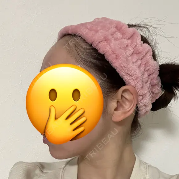 脂肪吸引（顔） 札幌ル・トロワ ビューティクリニックVogue DAY 123 メイン用