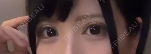 二重切開 / 目頭切開 / 眼瞼下垂（切開） / 上まぶたの脂肪取り エターナル美容クリニック DAY 79 メイン用