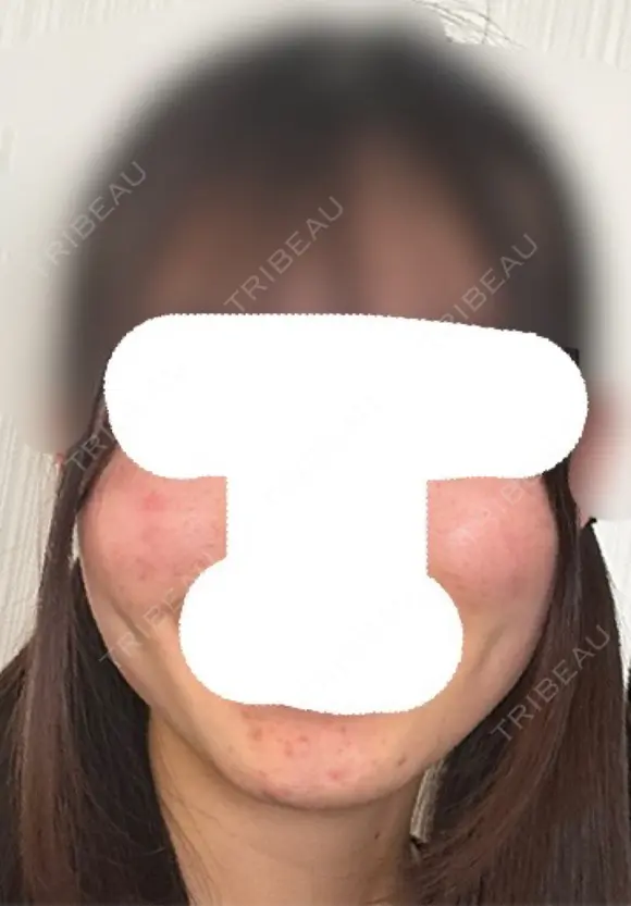 糸リフト / 脂肪吸引（顔） / ジョールファット除去 / ボトックス（エラ・小顔） ルラ美容クリニック 新宿院 DAY 161 メイン用