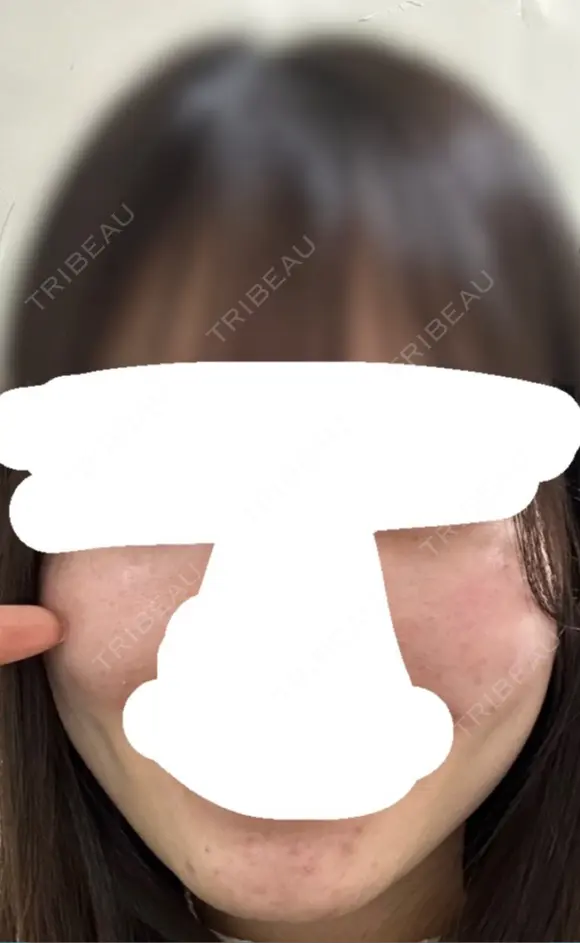 糸リフト / 脂肪吸引（顔） / ジョールファット除去 / ボトックス（エラ・小顔） ルラ美容クリニック 新宿院 DAY 159 メイン用