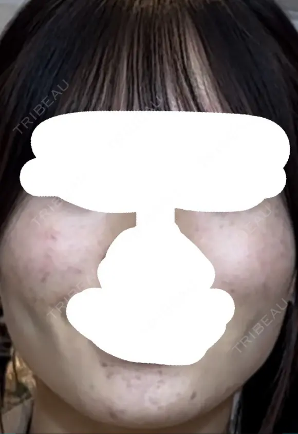 糸リフト / 脂肪吸引（顔） / ジョールファット除去 / ボトックス（エラ・小顔） ルラ美容クリニック 新宿院 DAY 163 メイン用