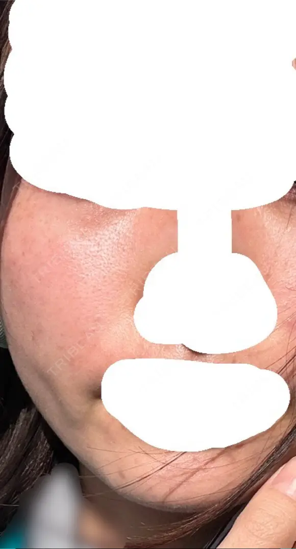 糸リフト / 脂肪吸引（顔） / ジョールファット除去 / ボトックス（エラ・小顔） ルラ美容クリニック 新宿院 DAY 166 メイン用