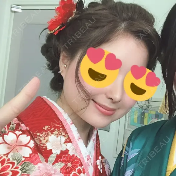 鼻尖形成（切開） / 鼻中隔延長（切開） / 小鼻縮小（切開） / 軟骨移植 / 鼻尖縮小 HANABI整形外科 DAY 7 メイン用