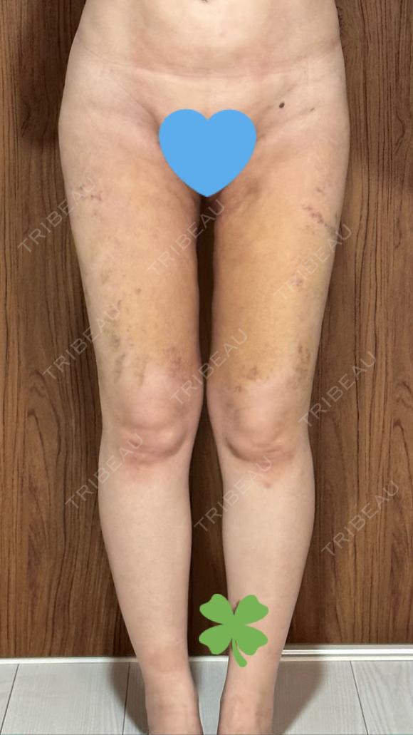 脂肪吸引（顔） / 脂肪吸引（脚） / 脂肪吸引（お尻） Mods Clinic（モッズクリニック） 福岡院 DAY 14 メイン用