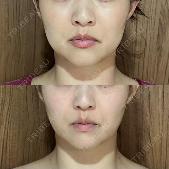脂肪吸引（顔） / 脂肪吸引（脚） / 脂肪吸引（お尻） Mods Clinic（モッズクリニック） 福岡院 DAY 14 メイン用