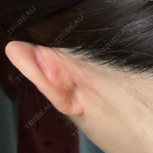 鼻尖形成（切開） / 軟骨移植 / 鼻尖縮小 ASTRA BEAUTY CLINIC DAY 228 メイン用