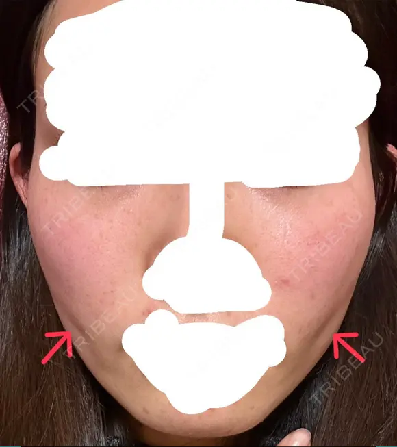 糸リフト / 脂肪吸引（顔） / ジョールファット除去 / ボトックス（エラ・小顔） ルラ美容クリニック 新宿院 DAY 171 メイン用