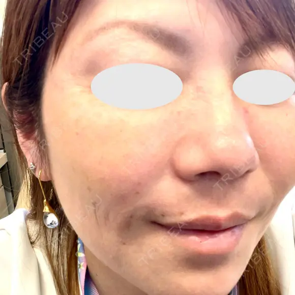 脂肪溶解注射（顔） / ヒアルロン酸注入（頬） / ボトックス（眉間） / ボトックス（目尻） / ハイフ（顔） TCB東京中央美容外科 立川院 DAY 2 メイン用