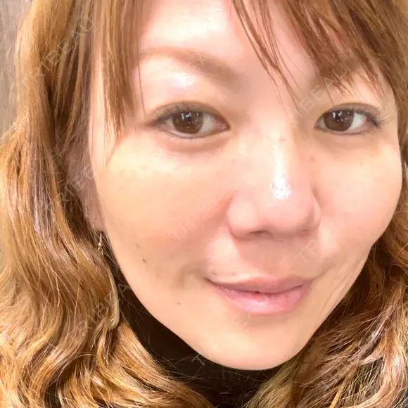 脂肪溶解注射（顔） / ヒアルロン酸注入（頬） / ボトックス（眉間） / ボトックス（目尻） / ハイフ（顔） TCB東京中央美容外科 立川院 DAY 6 メイン用