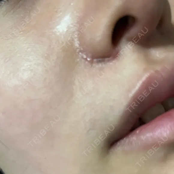 鼻尖形成（切開） / 軟骨移植 / 眉間プロテーゼ / 小鼻縮小（非切開） / 鼻柱下降・鼻唇角形成（猫手術） グローバルビューティークリニック 東京院 DAY 9 メイン用