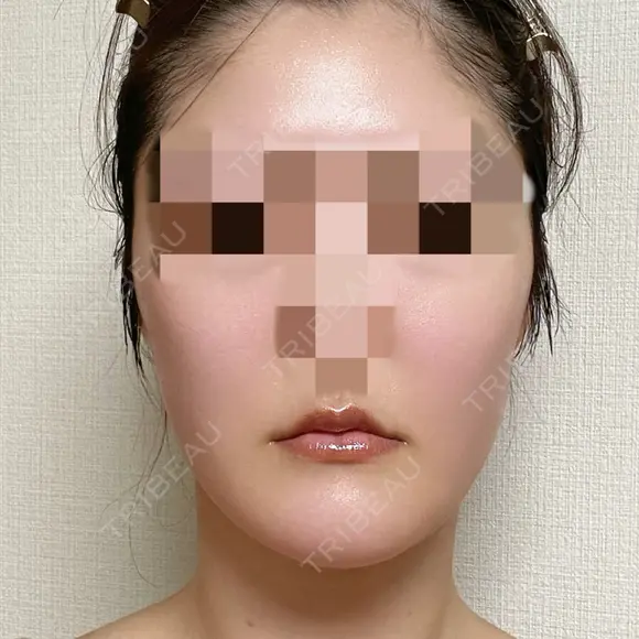 脂肪吸引（顔） 銀座マイアミ美容外科 DAY 86 メイン用