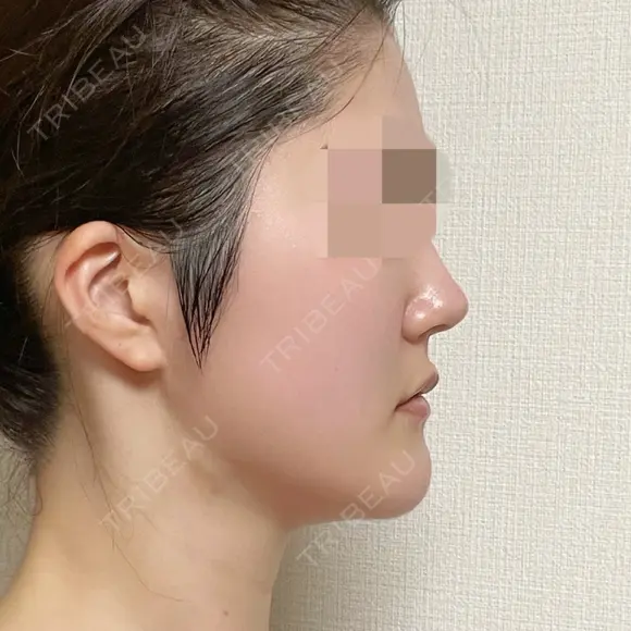 脂肪吸引（顔） 銀座マイアミ美容外科 DAY 86 メイン用