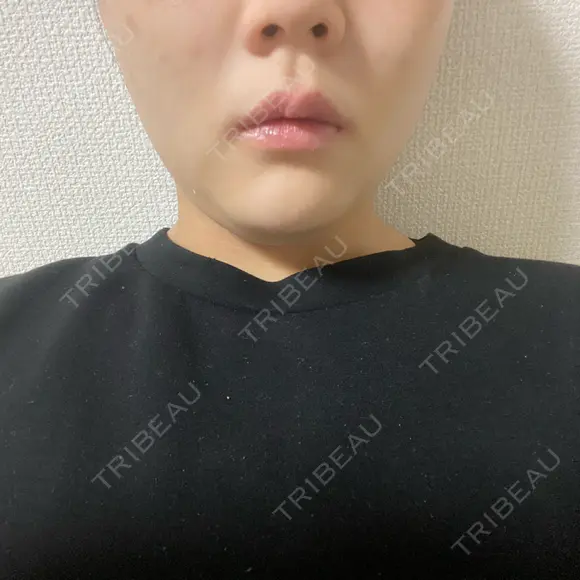 ボトックス（エラ・小顔） / 脂肪溶解注射（顔） TCB東京中央美容外科 京都駅前院 DAY 0 メイン用