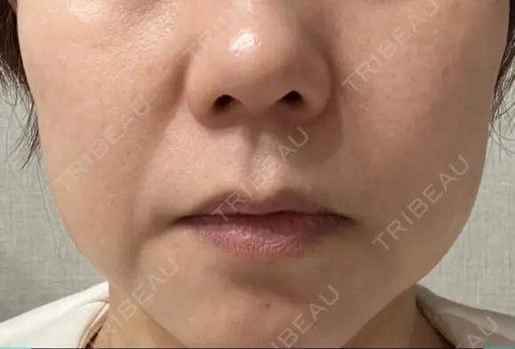 ピーリング（ハリ・ツヤ） LIFIX BEAUTY CLINIC AFTER メイン用