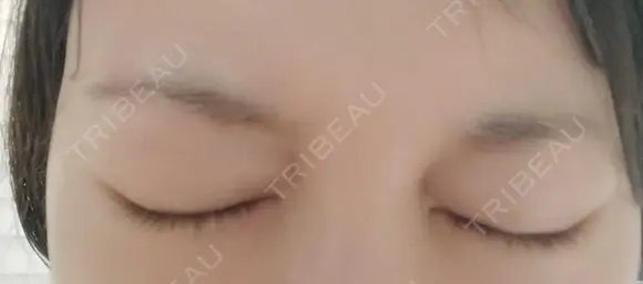 ボトックス（眉間） 湘南美容クリニック 本厚木院 AFTER メイン用