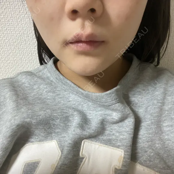 ボトックス（エラ・小顔） / 脂肪溶解注射（顔） TCB東京中央美容外科 京都駅前院 AFTER メイン用