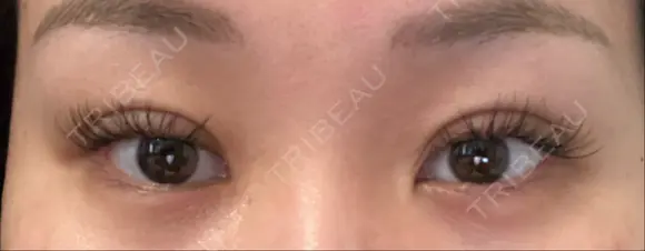 二重埋没 藤・ナチュレ美容クリニック 銀座院 DAY 1 メイン用