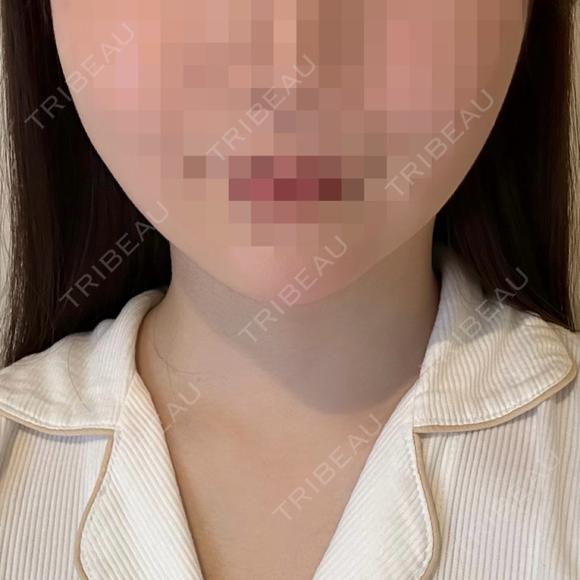 脂肪吸引（顔） / あご下筋肉縛り セギム美容整形外科 AFTER メイン用