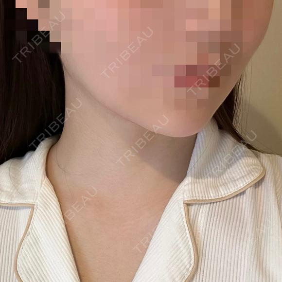 脂肪吸引（顔） / あご下筋肉縛り セギム美容整形外科 DAY 39 メイン用