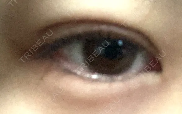 二重埋没 湘南美容クリニック 町田院 DAY 29 メイン用