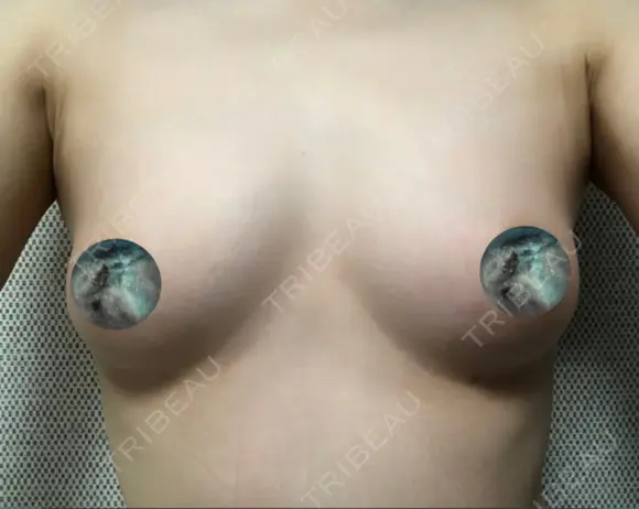 脂肪吸引（お腹） / 脂肪吸引（お尻） / 豊胸（脂肪注入） / その他（ボディ） ドクターフィット（Dr.fit）クリニック AFTER メイン用