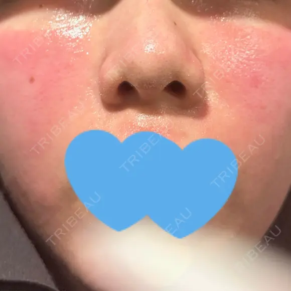 ポテンツァ ARTE BEAUTY CLINIC DAY 0 メイン用