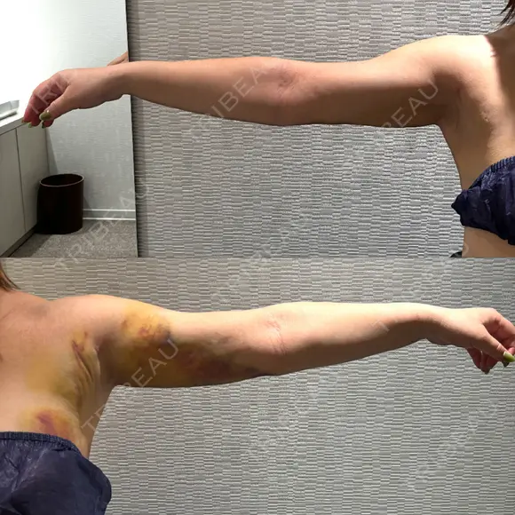 脂肪吸引（顔） / 脂肪吸引（二の腕） / 脂肪注入（額） / 脂肪吸引（肩） Mods Clinic（モッズクリニック） 福岡院 DAY 6 メイン用
