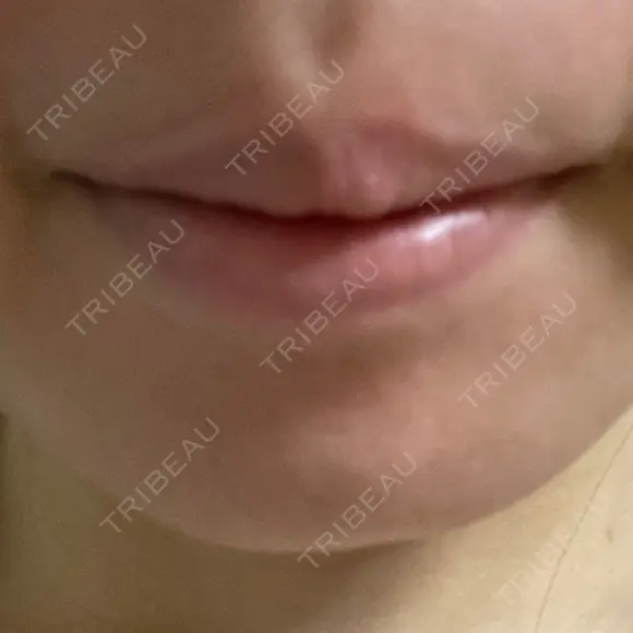 ボトックス（あご） ルラ美容クリニック 池袋院 DAY 0 メイン用