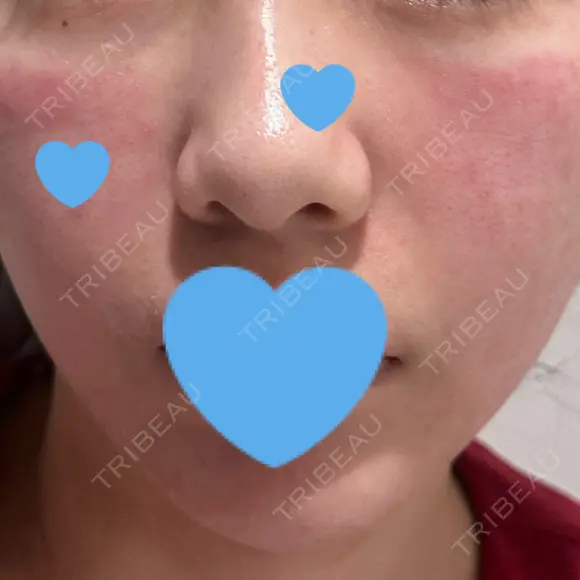ポテンツァ ARTE BEAUTY CLINIC DAY 1 メイン用