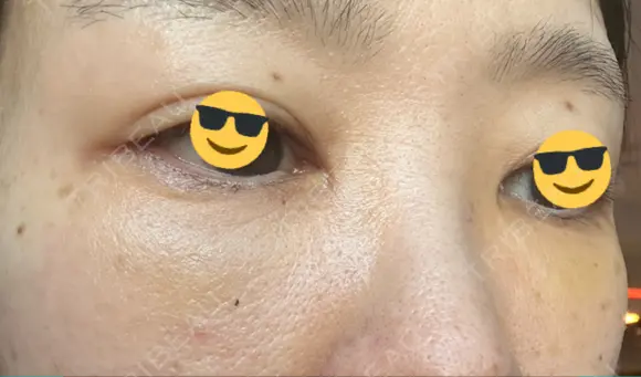 下まぶたの脂肪取り / 脂肪注入（目の下） セオリークリニック DAY 7 メイン用