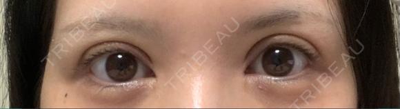 二重切開 / 目頭切開 / 眼瞼下垂（切開） / 上まぶたの脂肪取り エターナル美容クリニック DAY 89 メイン用