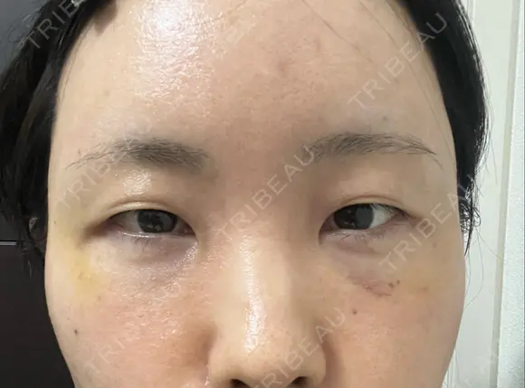 クマ治療 / こめかみ形成 / 脂肪注入（額） / 脂肪注入（目の下） / ボトックス（額） X CLINIC 銀座院 DAY 12 メイン用