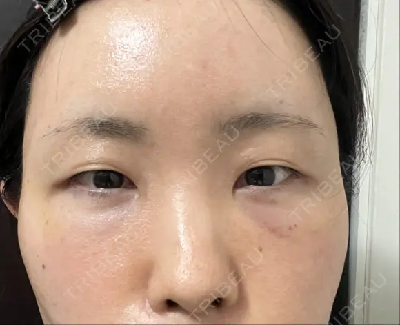 クマ治療 / こめかみ形成 / 脂肪注入（額） / 脂肪注入（目の下） / ボトックス（額） X CLINIC 銀座院 DAY 14 メイン用