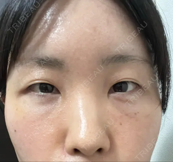 クマ治療 / こめかみ形成 / 脂肪注入（額） / 脂肪注入（目の下） / ボトックス（額） X CLINIC 銀座院 DAY 15 メイン用