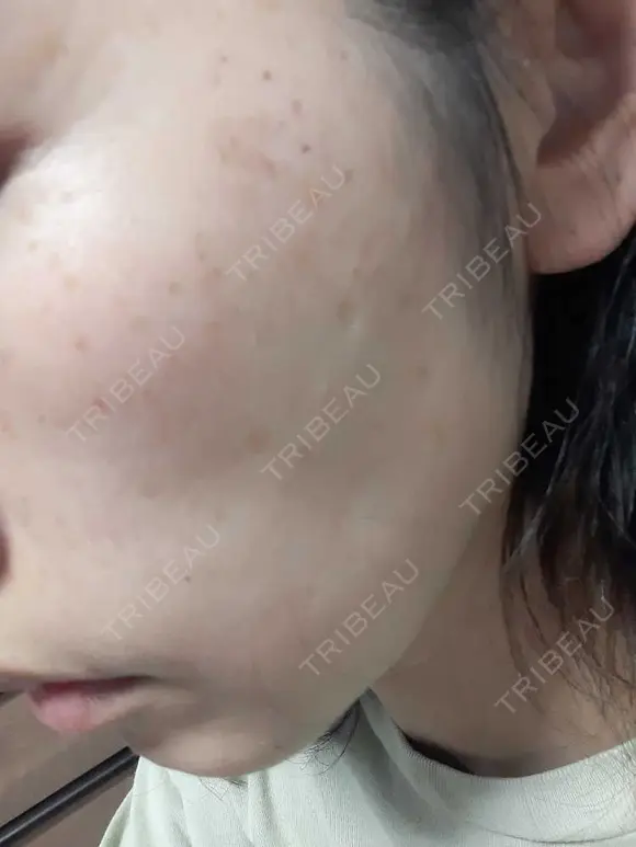 光治療（フォトフェイシャルなど） DMTC美容皮膚科 大宮院 AFTER メイン用
