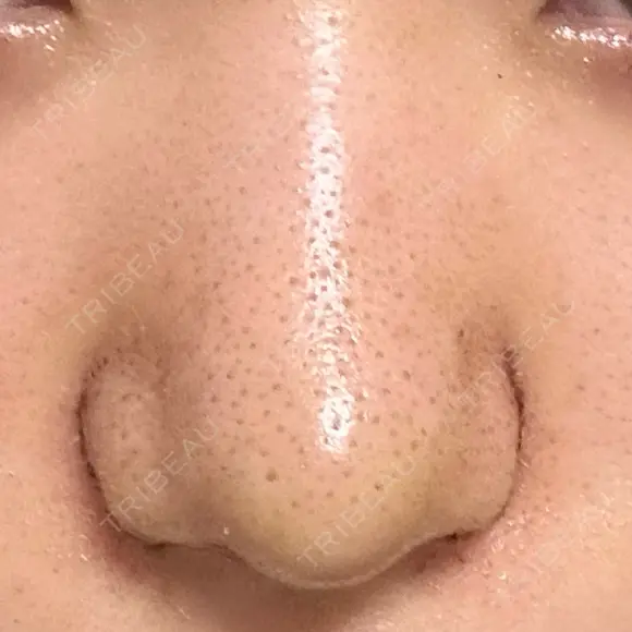 鼻尖形成（切開） / 小鼻縮小（切開） / その他（鼻） 東京形成美容外科 船橋院 DAY 4 メイン用