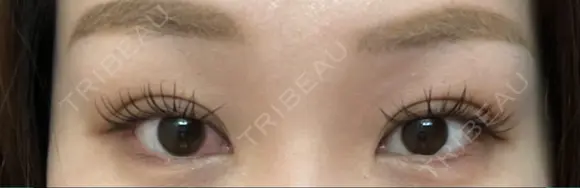 二重埋没 藤・ナチュレ美容クリニック 銀座院 DAY 6 メイン用