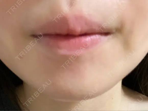 ボトックス（あご） ルラ美容クリニック 池袋院 DAY 2 メイン用