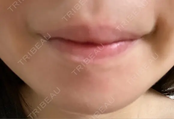 ボトックス（あご） ルラ美容クリニック 池袋院 AFTER メイン用