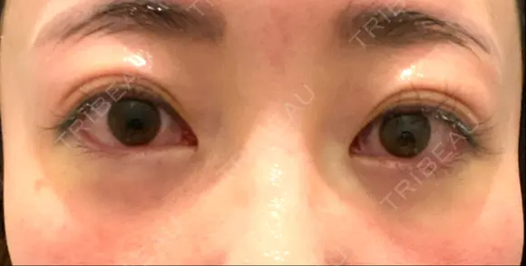 クマ治療 藤・ナチュレ美容クリニック 銀座院 DAY 0 メイン用
