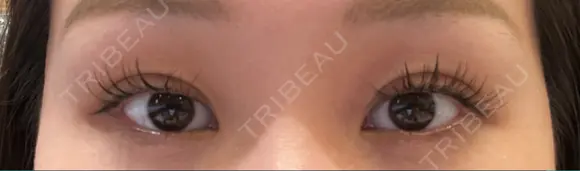 二重埋没 藤・ナチュレ美容クリニック 銀座院 DAY 7 メイン用