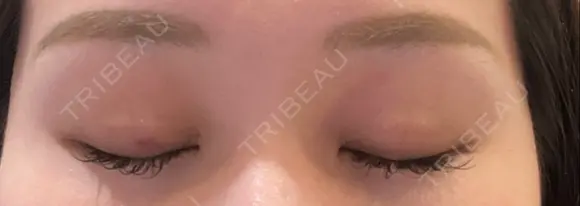 二重埋没 藤・ナチュレ美容クリニック 銀座院 DAY 7 メイン用