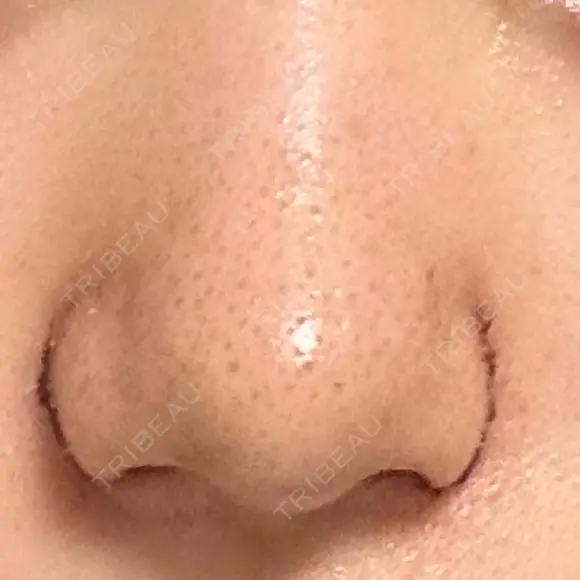 鼻尖形成（切開） / 小鼻縮小（切開） / その他（鼻） 東京形成美容外科 船橋院 DAY 6 メイン用