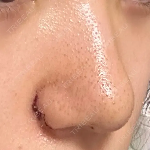 鼻尖形成（切開） / 小鼻縮小（切開） / その他（鼻） 東京形成美容外科 船橋院 DAY 6 メイン用