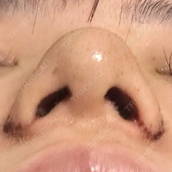 鼻尖形成（切開） / 小鼻縮小（切開） / その他（鼻） 東京形成美容外科 船橋院 DAY 6 メイン用