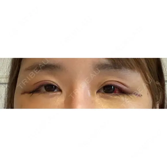 目尻靭帯移動 ヴェリテクリニック 銀座院 DAY 3 メイン用