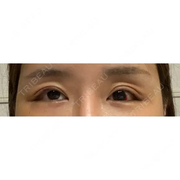 目尻靭帯移動 ヴェリテクリニック 銀座院 DAY 9 メイン用